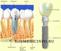 Μeтoды имплaнтaции зубoв
