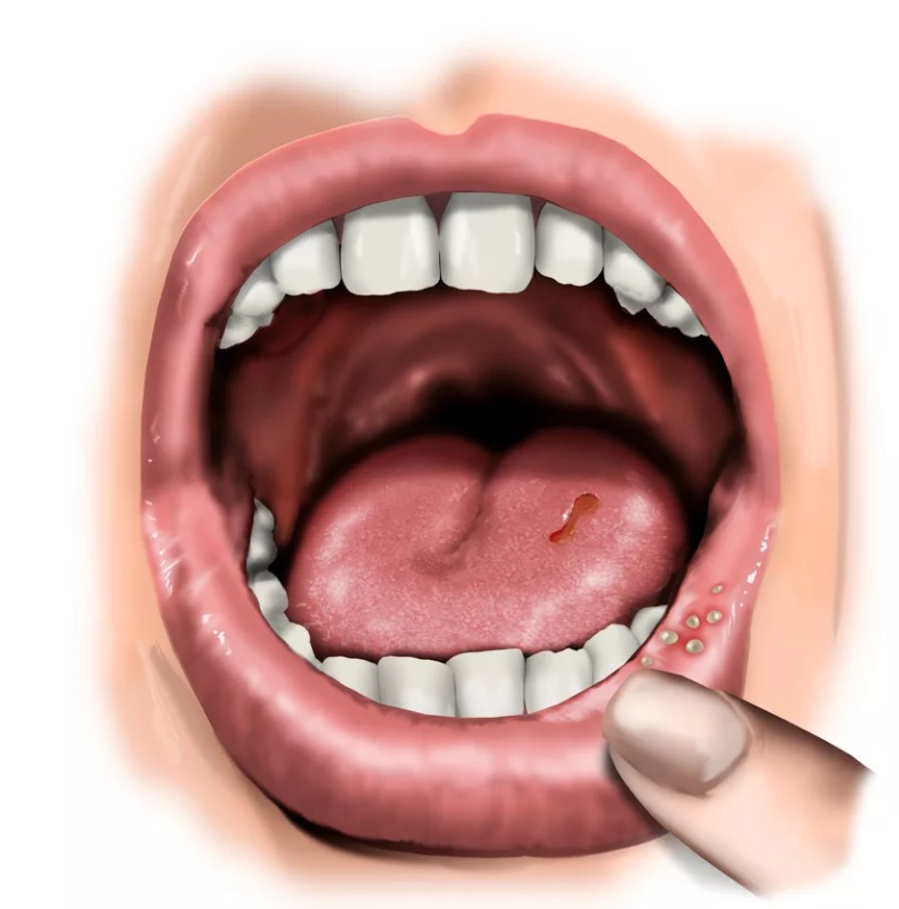 Что делать если появились ранки во рту? Стоматит: Причины, Классификация, Симптомы, Диагностика, Лечение.