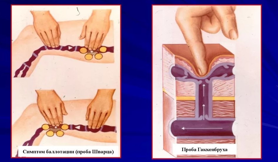 Пробы для выявления клапанной недостаточности подкожных вен.