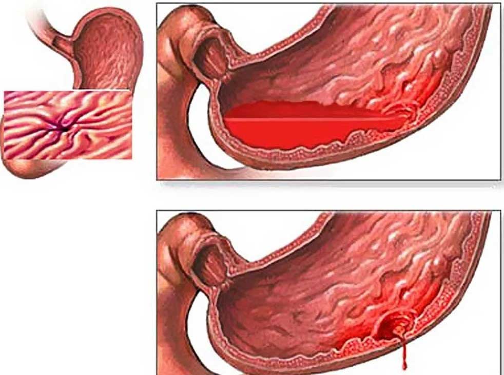 Симптомы ЯБЖ и двенадцатиперстной кишки, осложненная кровотечением