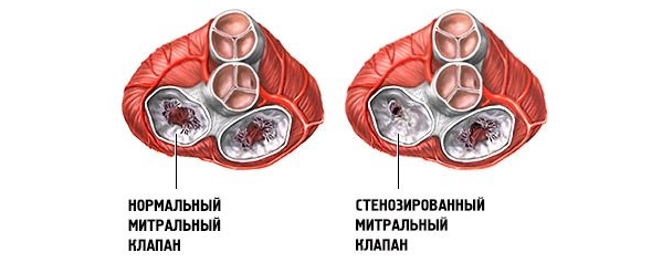 Ответы к ситуационной задаче: "Ревматический стеноз левого митрального отверстия в стадии декомпенсации"