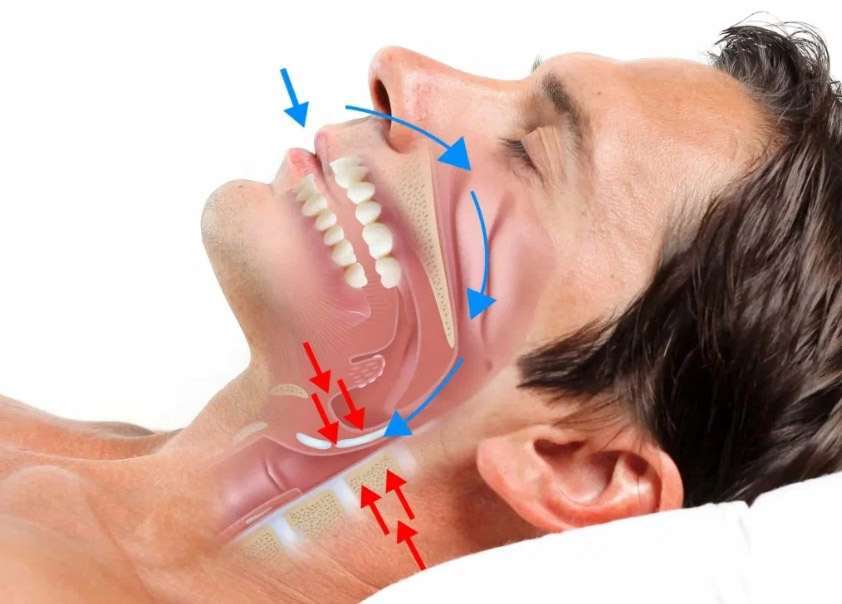 Тактика лечения храпа и апноэ