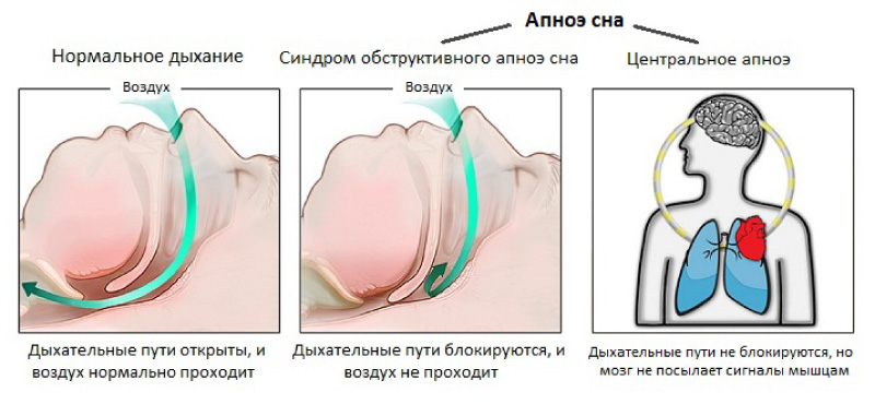 Нормально прошел. Синдром обструктивного апноэ сна у детей. Синдром центрального апноэ. Синдром центрального ночного апноэ. Причины остановки дыхания у детей.