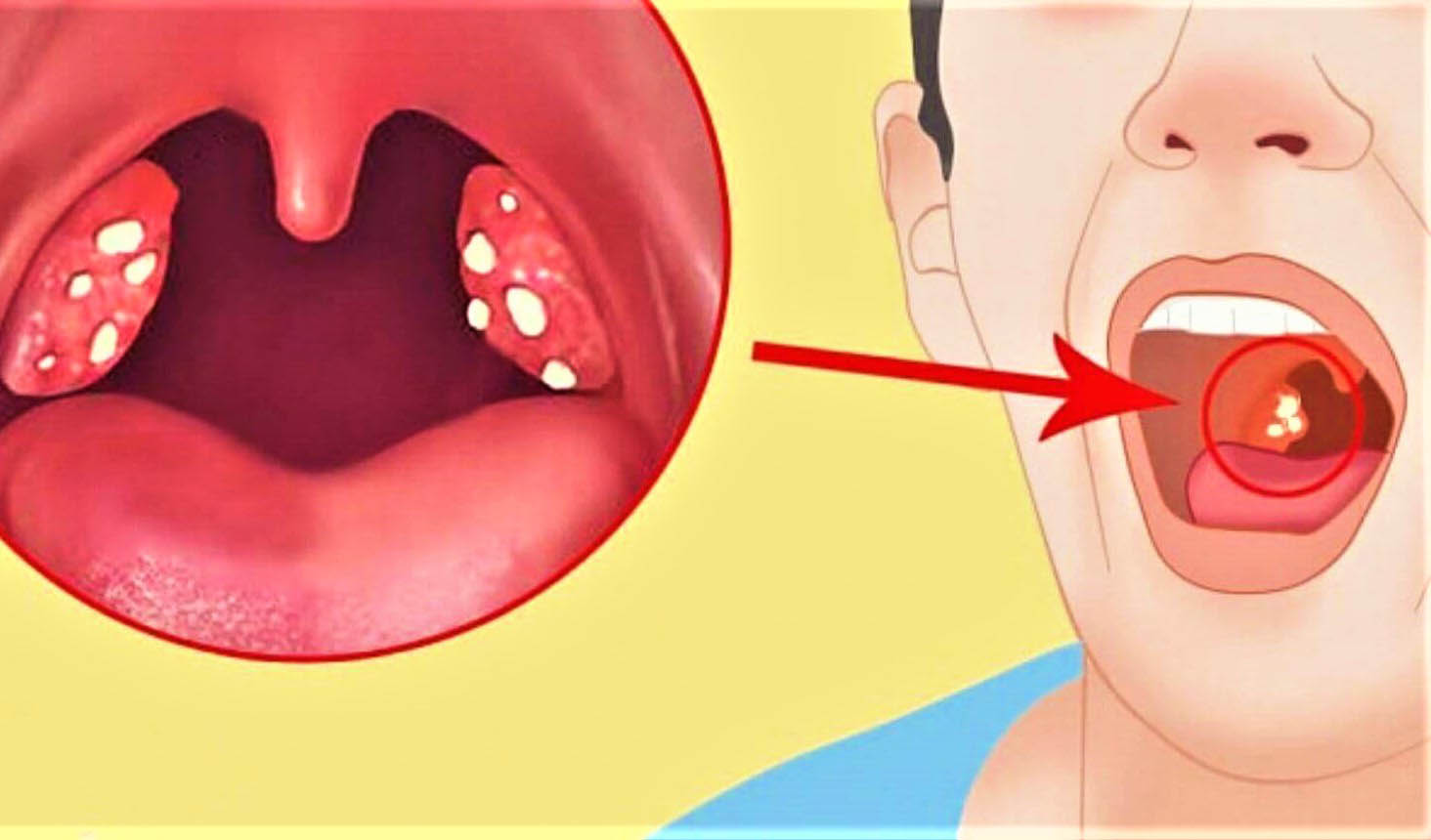 Ходит вирус болью в горле. Фарингит тонзиллит скарлатина. Гнойная ангина лакунарная.