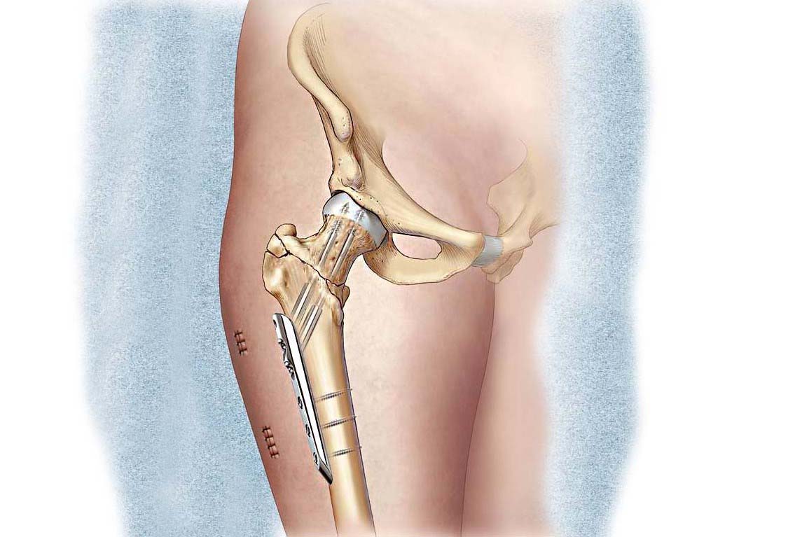 Остеосинтез шейки бедра: причины, методы, лечение.