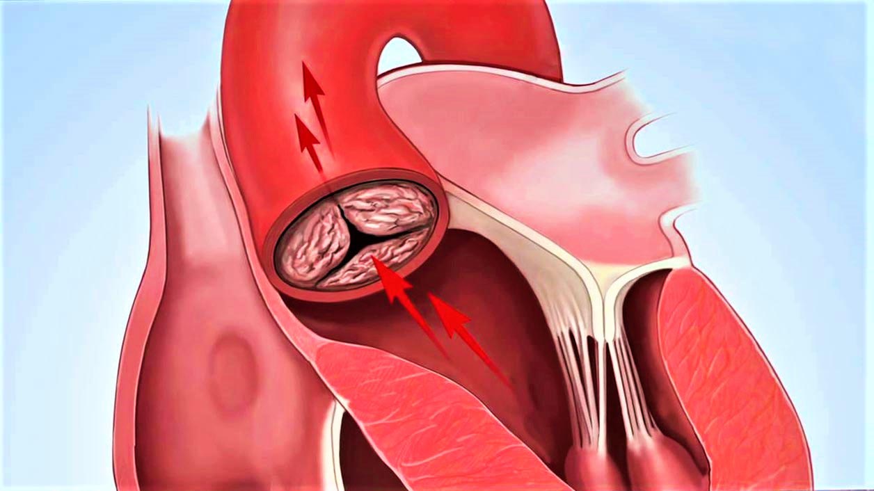 Уплотнение стенок аорты створок аортального клапана. Anemia in Aortic Stenosis. Дивертикул Коммереля аорты.