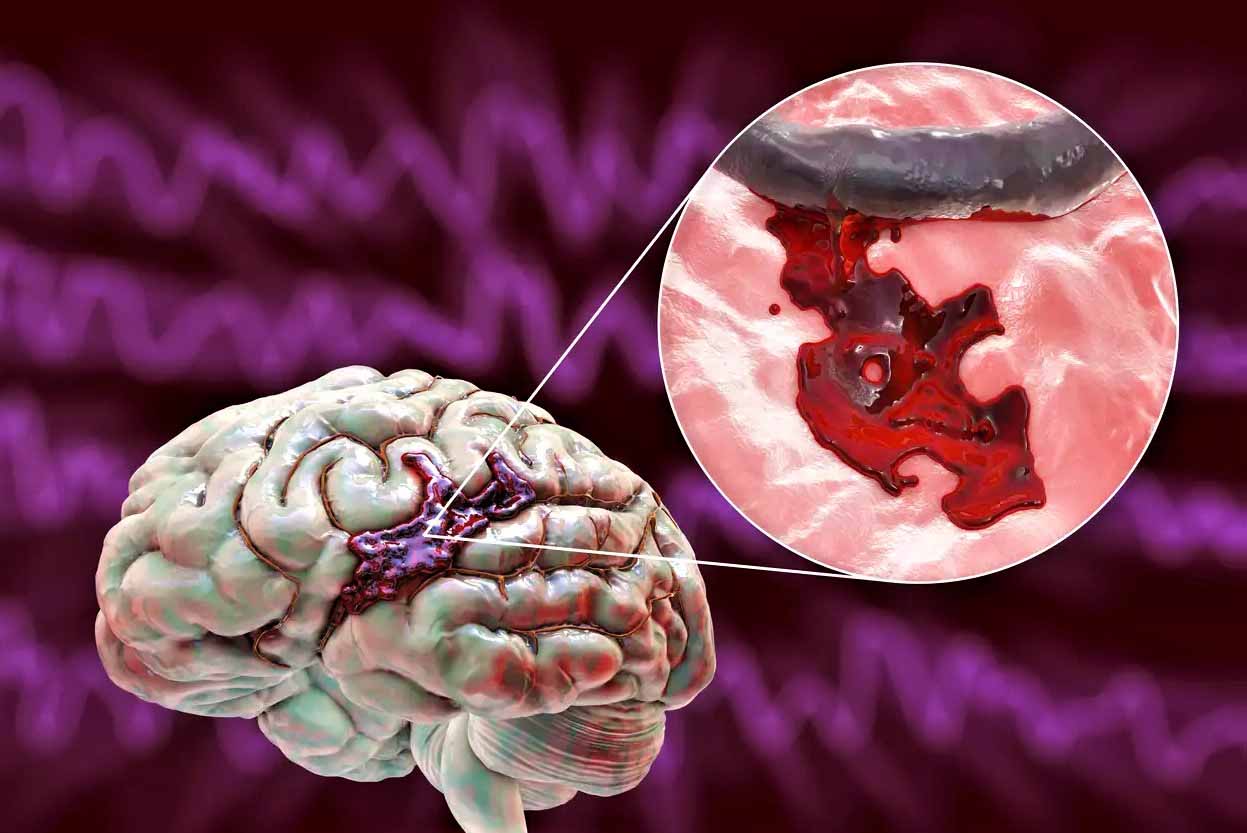Геморрагический инсульт у беременных: осложнение и симптомы