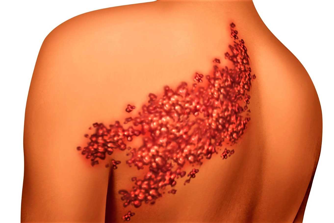 кожные заболевания груди у женщин фото 93