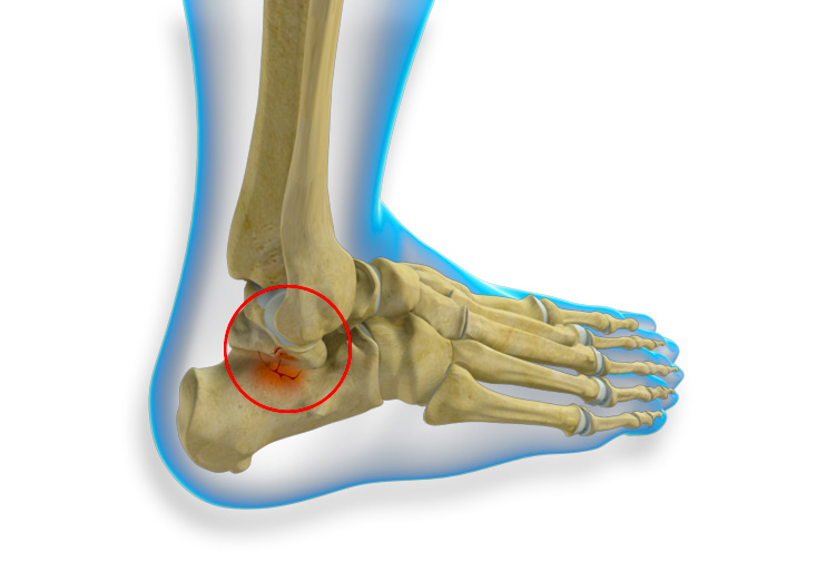 Передневнутреннее смещение таранной кости: причины и симптомы
