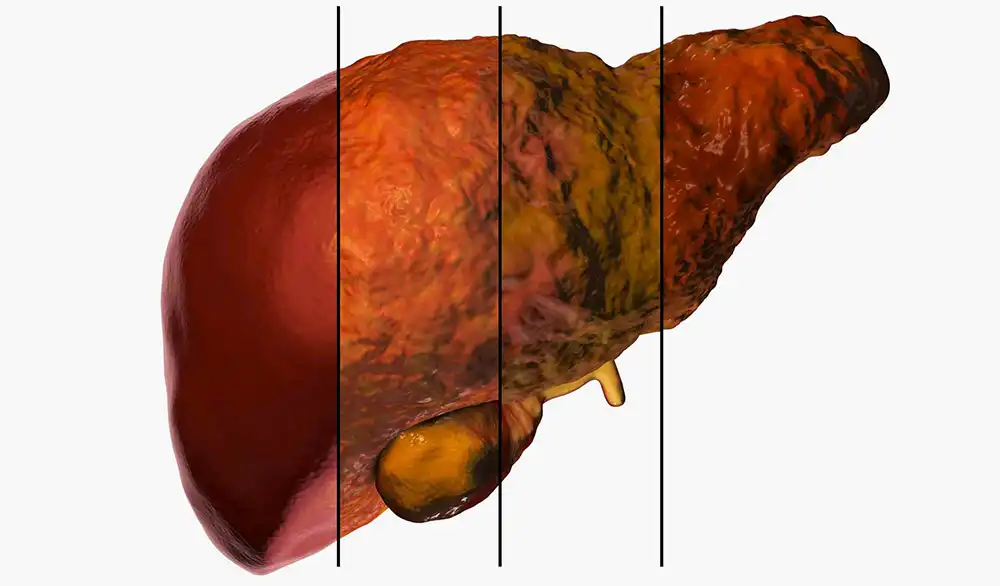 Темная сторона печени: познакомьтесь с деградацией, о которой вы не подозревали