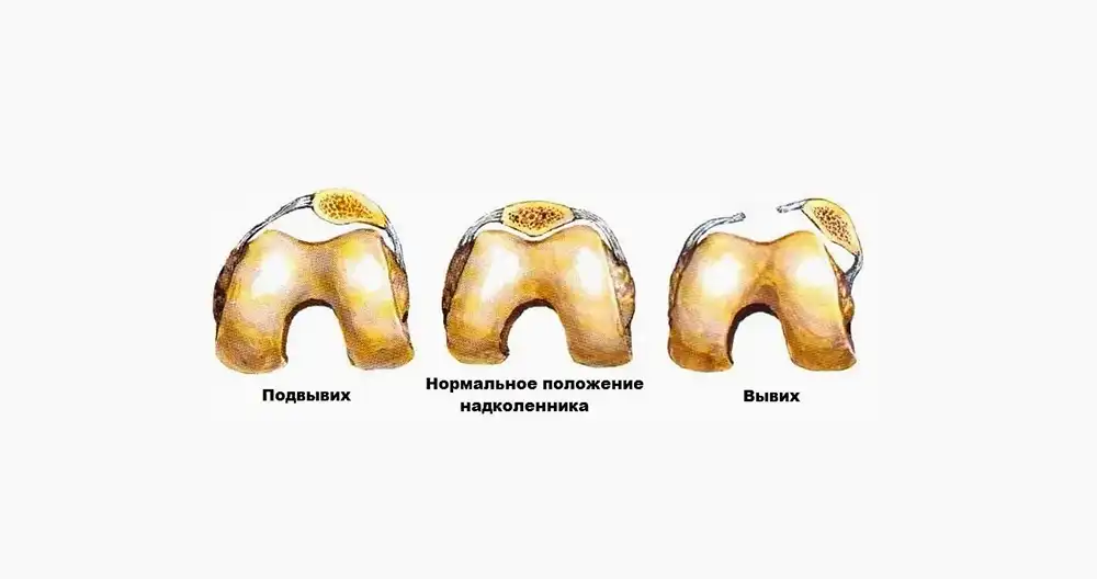 Ответы к тестам НМО: "Вывих надколенника (по утвержденным клиническим рекомендациям)-2021"