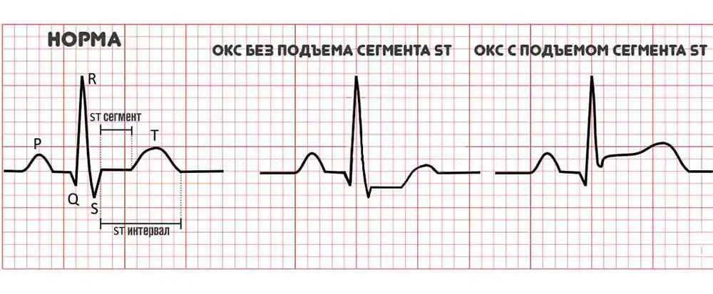 Ответы к тестам НМО: "Острый коронарный синдром без подъема сегмента ST электрокардиограммы (по утвержденным клиническим рекомендациям) - 2024"